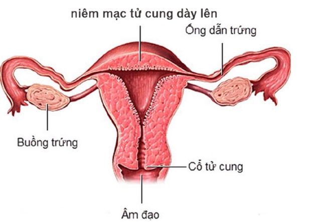 niêm mạc tử cung dày báo hiệu điều gì niêm mạc tử cung dày báo hiệu điều gì